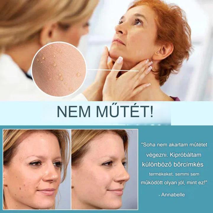 CoverLux™ Tapaszok a bőrfoltok és anyajegyek eltávolítására