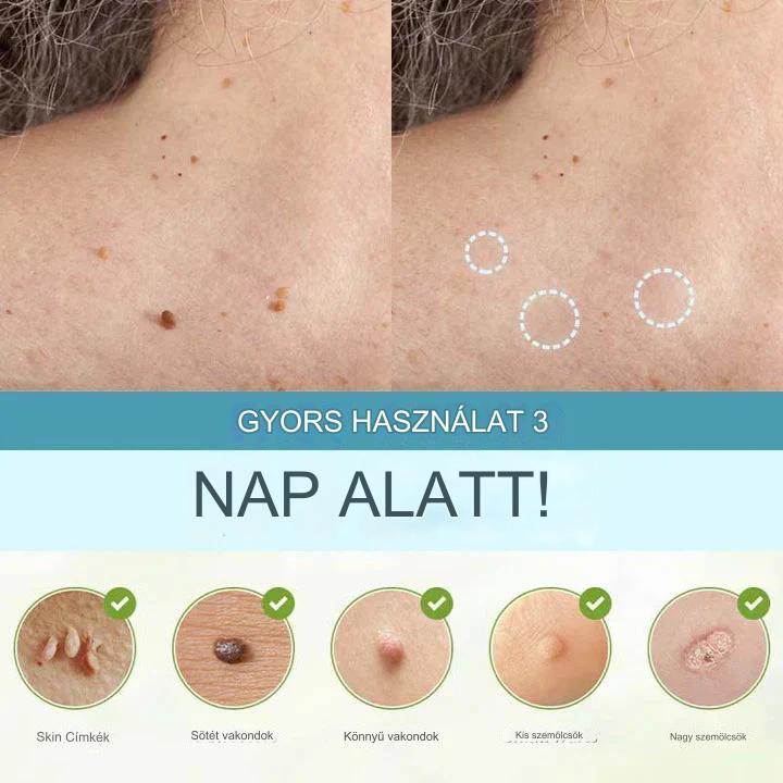 CoverLux™ Tapaszok a bőrfoltok és anyajegyek eltávolítására