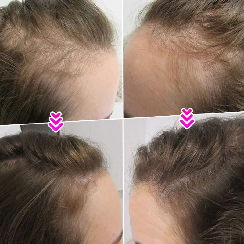 EELHOE HAIR™ Púder hajhullás ellen és a hajvonal gyors feltöltése