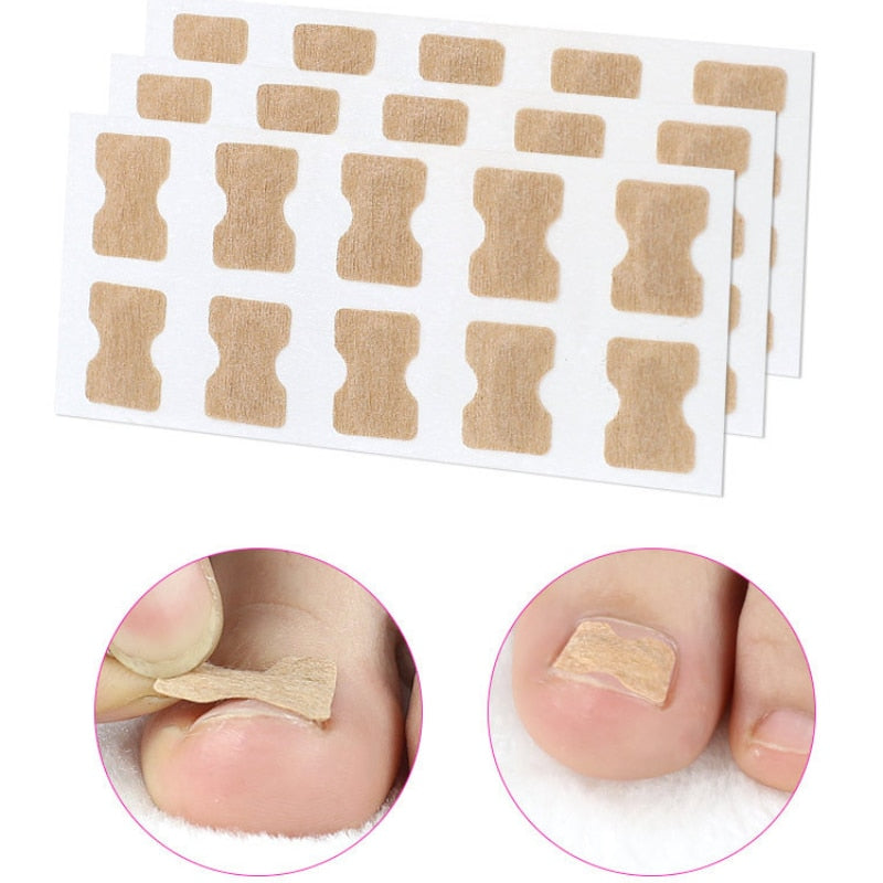ToeFix+ Körömtapaszok | Szabaduljon meg a benőtt körmöktől!