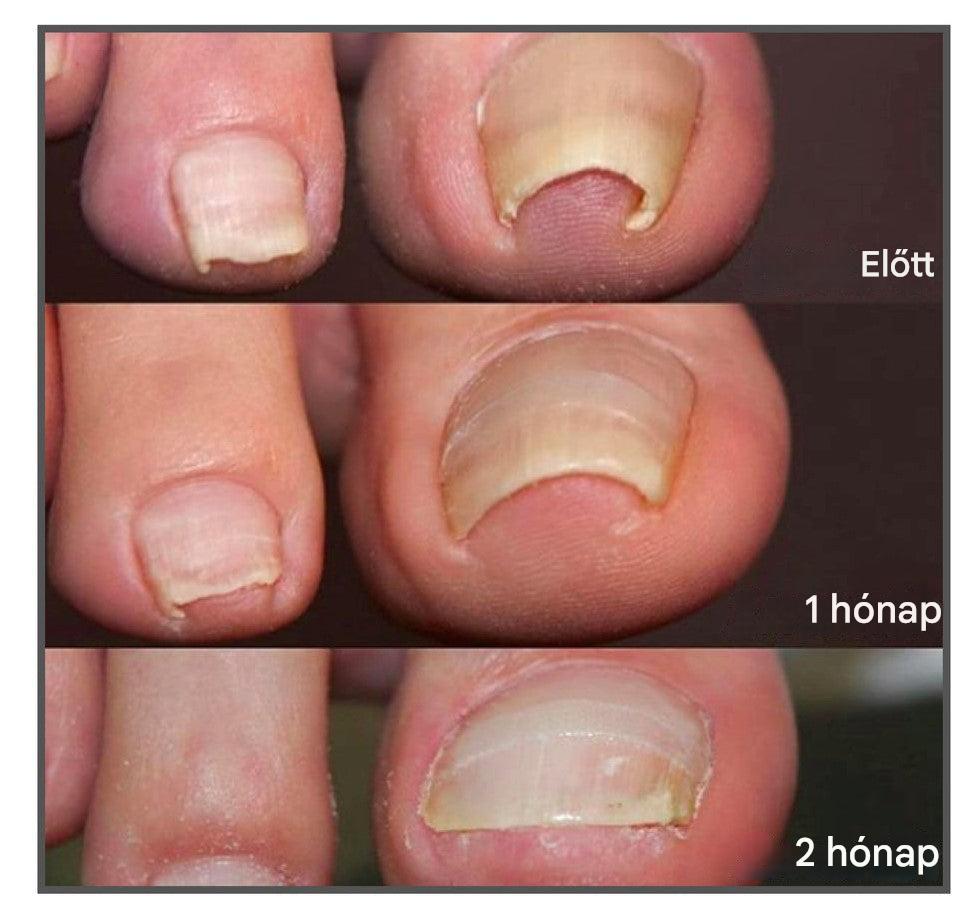 ToeFix+ Körömtapaszok | Szabaduljon meg a benőtt körmöktől!