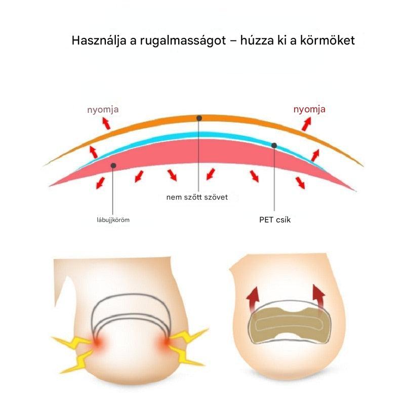 ToeFix+ Körömtapaszok | Szabaduljon meg a benőtt körmöktől!