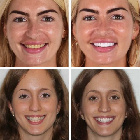 Vital Smile™ Super Probiotic-6 fogkrém 6 probiotikummal