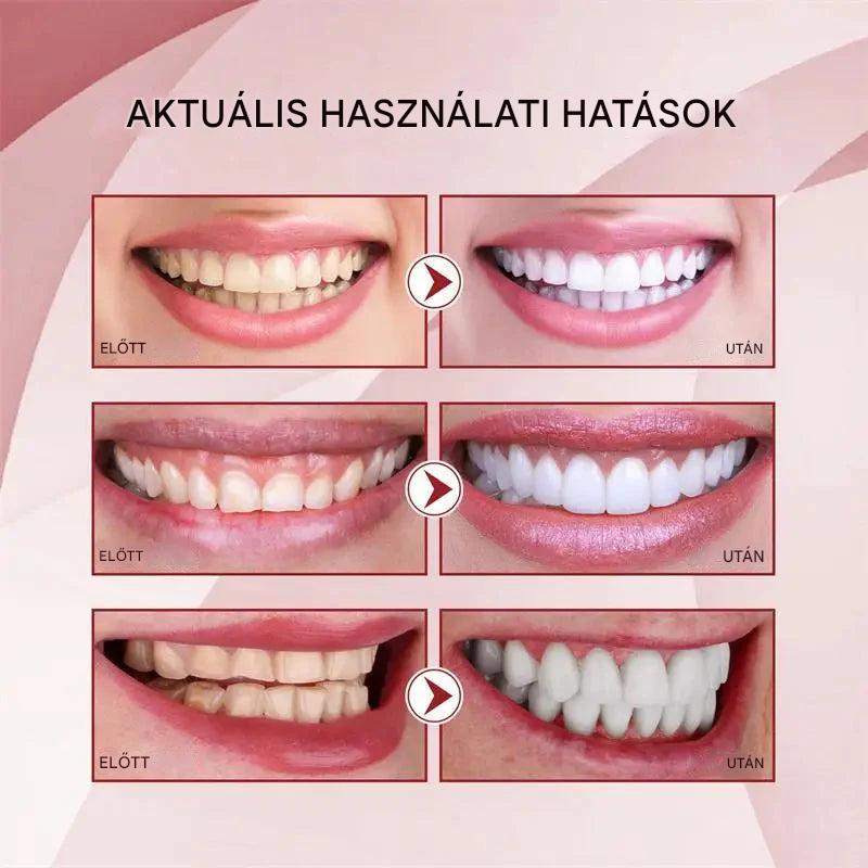 Vital Smile™ Super Probiotic-6 fogkrém 6 probiotikummal